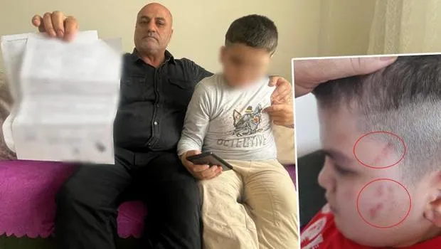 Bursa'da otizmli öğrencide 54 morluk: Öğretmen açığa alındı